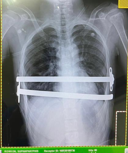 pectus-excavatum-treatment-01