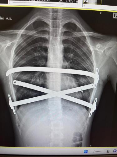 pectus-excavatum-treatment-02