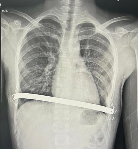 pectus-excavatum-treatment-03