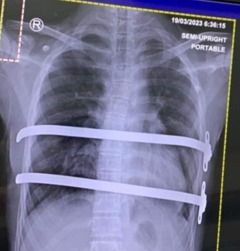 pectus-excavatum-treatment-04