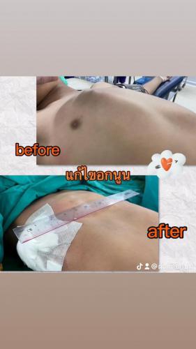 รีวิวผลการผ่าตัดอกนูน