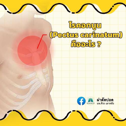 solve-doubts-pectus-carinatum-01