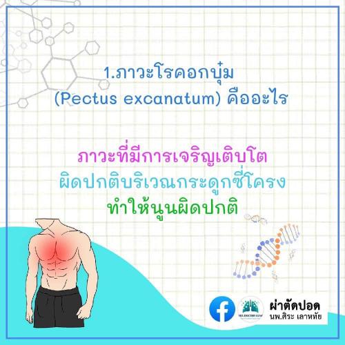 solve-doubts-pectus-excavatum-02