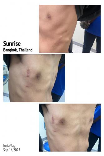 wound-after-surgery-01