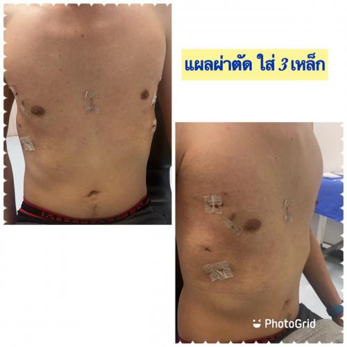 wound-after-surgery-02
