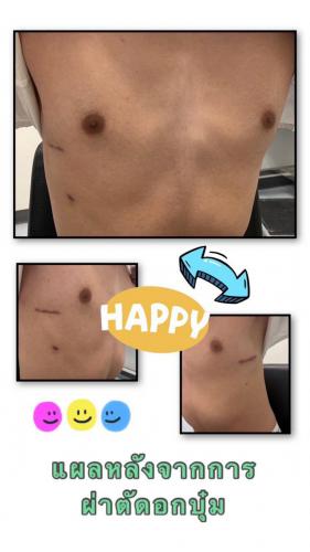 wound-after-surgery-03