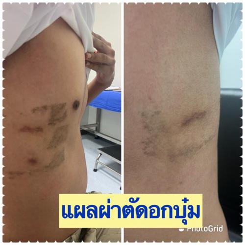 wound-after-surgery-04