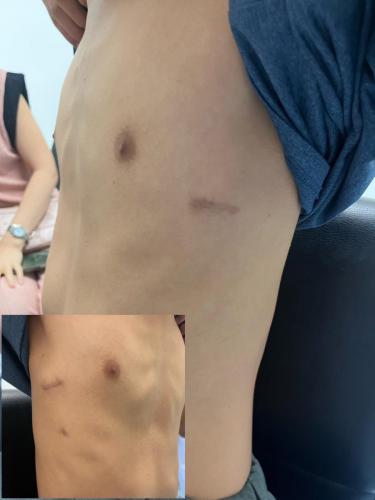 wound-after-surgery-05