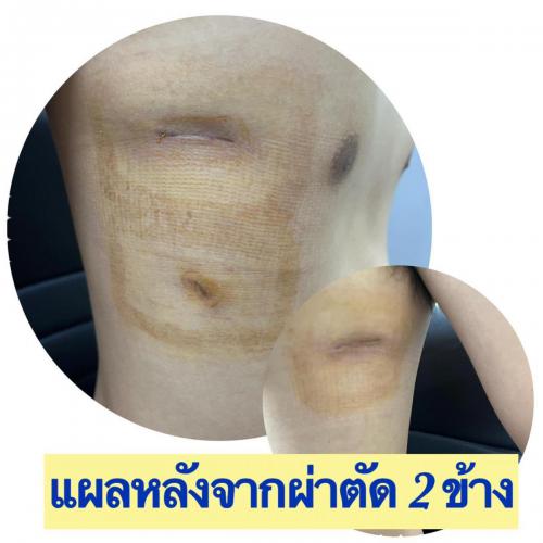 รีวิวลักษณะแผลหลังผ่าตัด